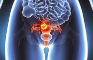 A melhor maneira de não ser surpreendida pelo câncer do colo de útero é a prevenção e esta pode ser feita nas redes públicas municipais (Posto de Saúde), através do exame do Papanicolau.